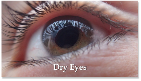 Dry Eyes